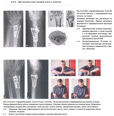 Перелом головки лучевой кости | ortoped-klinik.com