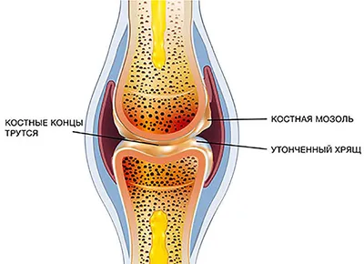 Переломы и несращение ключицы