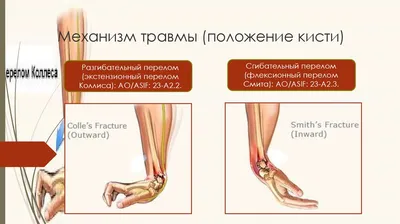 Лечение неправильно росшегося перелома лучевой кости