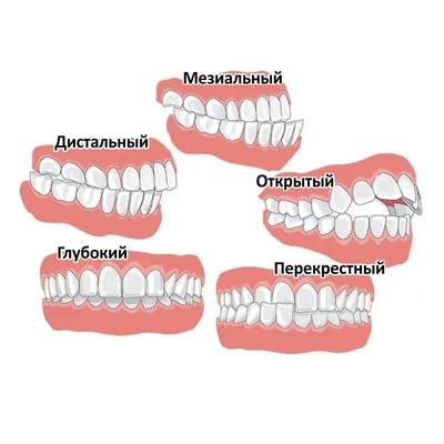 Как определить правильный прикус? - блог стоматологии