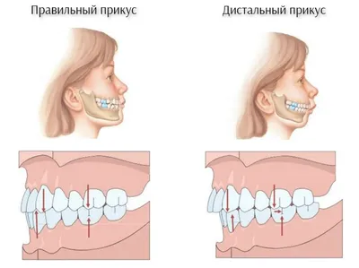 Неправильный прикус | Стоматология «АльтоДент» в Орехово-Зуево