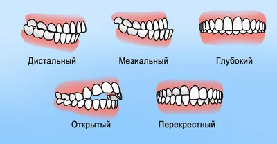 Как исправить дистальный прикус - современные методы лечения | НАВА