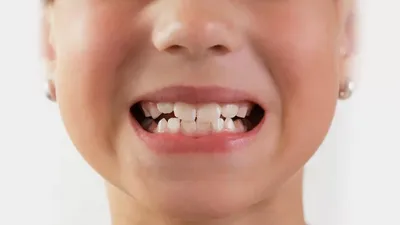 Неправильный прикус: причины, последствия, способы исправления | Центр  стоматологии «Ваш Стоматолог»