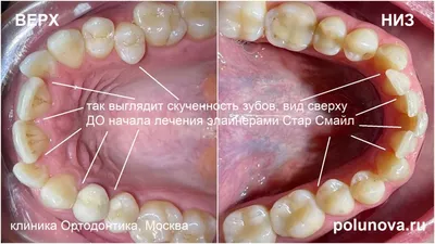 Неправильный прикус зубов виды и способы лечения в Минске, «Брекетлаб»