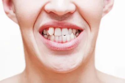 Неправильный прикус зубов - виды, причины, как определить, лечение  (брекеты) у ребенка и взрослых