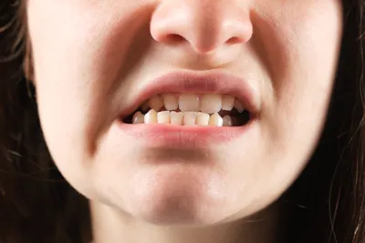 Неправильный прикус: зубов у ребенка, нижняя челюсть, фото, как определить