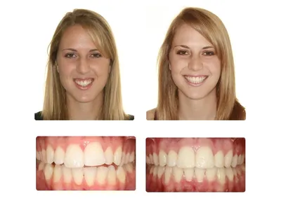DentalTravel - Неправильный прикус (или патологический прикус) —  неправильное расположение зубов в ротовой полости. Виды неправильного  прикуса: 1⃣ Мезиальный — нижняя челюсть заметно выступает вперёд 2⃣  Глубокий — верхняя челюсть «загораживает» нижнюю.