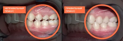 Неправильный прикус: зубов у ребенка, нижняя челюсть, фото, как определить