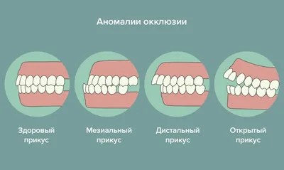 Как исправить неправильный прикус? | Стоматология Atlantis Dental