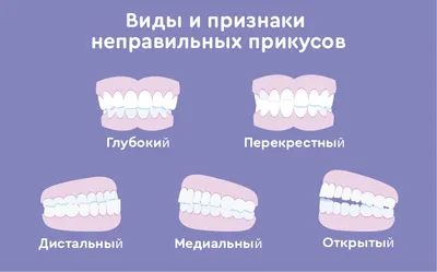 Неправильный прикус или готовность остаться без зубов