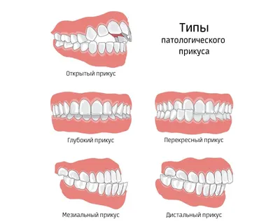 Как определить правильный и неправильный прикус: подробно о проблеме прикуса