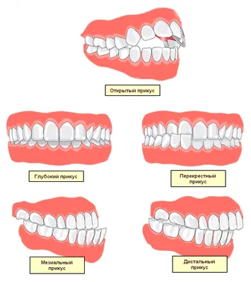 Неправильный прикус у взрослого и ребенка: какой бывает и почему это  проблема