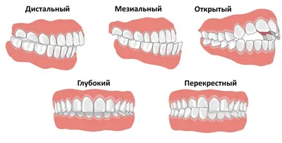 Исправление прикуса (до/после)