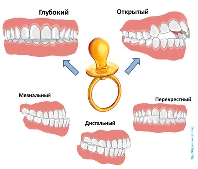 Виды прикуса человека - как он формируется, последствия, особенности лечения