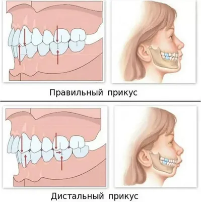 С каким проблемами можно столкнуться из-за неправильного прикуса?