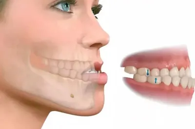Прикус зубов и его исправление. Неправильный прикус: лечение брекетами у  детей и у взрослых