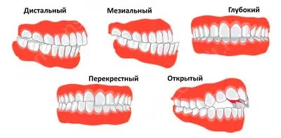 Неправильный прикус у взрослого и ребенка: какой бывает и почему это  проблема