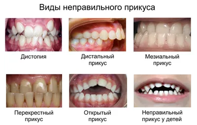 Как исправить прикус и стоит ли это делать?