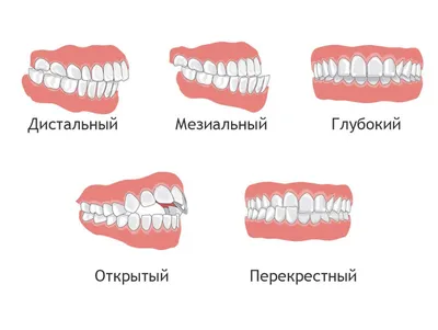 Российский врач: неправильный прикус может испортить вам здоровье — Ferra.ru