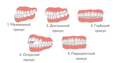 Правильный и неправильный прикус