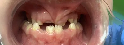 Реконструкция прикуса и зубов