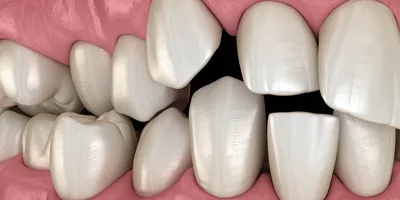 Зачем нужно исправлять прикус? 🤔 Неправильный прикус, неровные зубы – не  только эстетическая проблема: 🦷Неправильный прикус, неровные… | Instagram