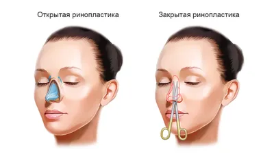 Примеры неудачной ринопластики: комментарии и советы от хирургов | Клиника  Доктора Росса