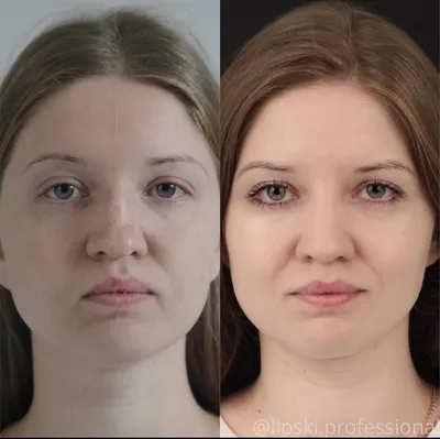 Ринопластика: фото до и после хирургической коррекции