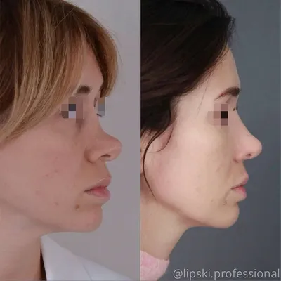 Ринопластика: корректируем горбинку носа - Cosmetic-clinic