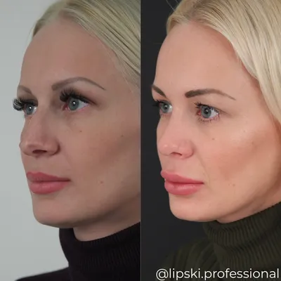 Ринопластика длинного носа в Москве - цены, отзывы, реальные фото до и после  | Александр Маркушин пластический хирург