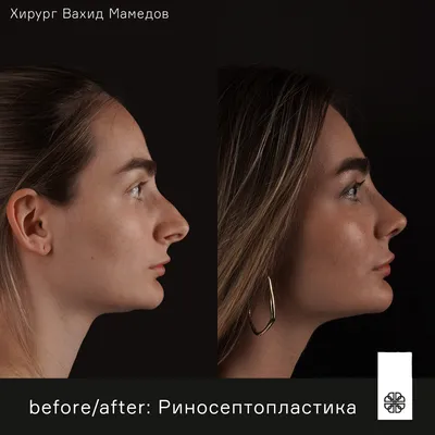 Ринопластика курносого носа в Москве - цены, отзывы, реальные фото до и  после | Александр Маркушин пластический хирург