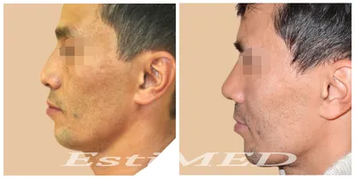 Ринопластика кончика носа. | Ринопластика, Косметология, Пластическая  хирургия