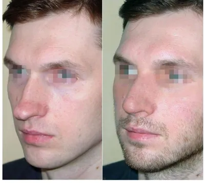 Пластика лица до и после операции - 75 фото