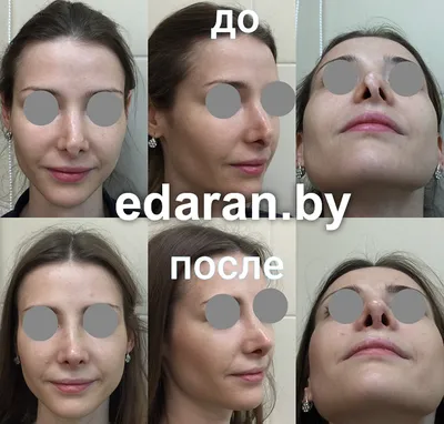 Ринопластика носа с толстой кожей в Москве - Damas Medical Center