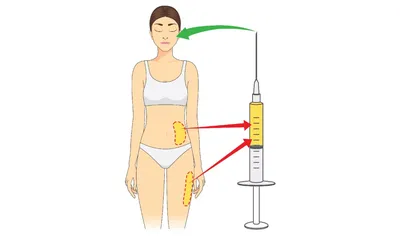 Нюансы липофилинга: плюсы и минусы пересадки собственного жира