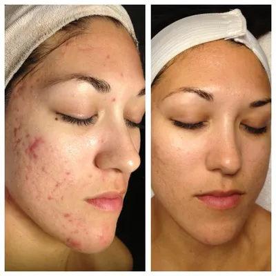 Эффект посещения косметолога: фото до и после
