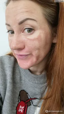 Вся правда о восстановлении лица после чистки у косметолога! | Красота и  уход | Дзен