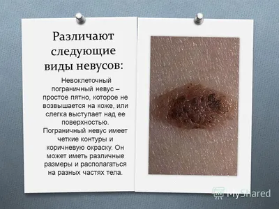 Невус - что это? Невусы на коже: виды, описание, фото | клиника Лазерсвiт в  Одессе