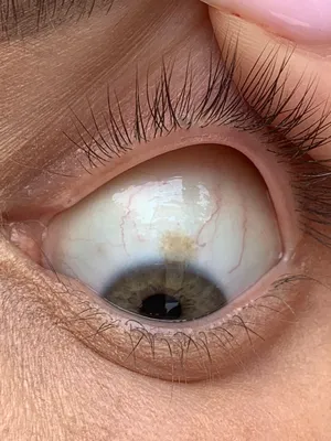 Желтые пятна на белке глаза: причины, диагностика и лечение в ГКДБ