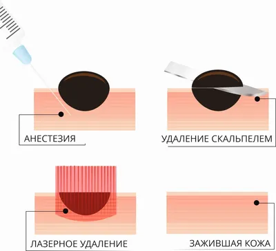 Меланоформный невус и глаз-алмаз.