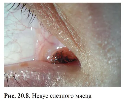 Невусы (в простонародье родинки) есть у... | Интересный контент в группе  Центр лазерной микрохирургии глаза – Око центр