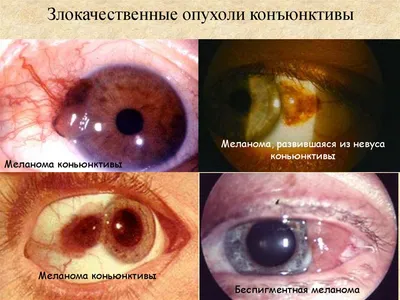 Невус в глазу - причины, симптомы и лечение