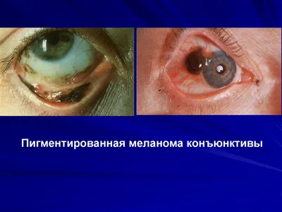 ▷ Опасен ли глазной или лунный невус в глазу? - Área Oftalmológica