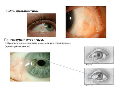 Невус конъюнктивы- есть ли повод для беспокойства? - Вопрос офтальмологу -  03 Онлайн