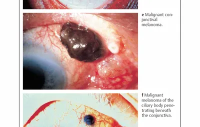 PDF) THE FIRST EXPERIENCE WITH INGARON TREATMENT FOR CONJUNCTIVAL MELANOMA