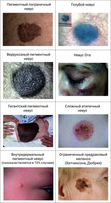 Папилломатозный невус - признаки, причины, симптомы, лечение и профилактика  - iDoctor.kz