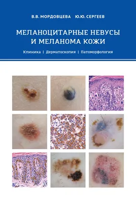 Доброкачественные и злокачественные невусы: тревожные признаки больших  родинок - ОГБУЗ \"Центр общественного здоровья и медицинской