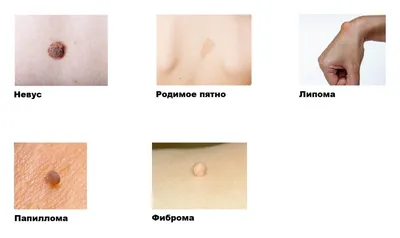 Гало-невус или витилиго? — Курсы по дерматоскопии | Юрий Сергеев