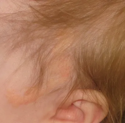 Косметология City Clinic. Иркутск - ⏺ Папилломатозный невус - это  выступающая над поверхностью кожи бугристая родинка. Относится к  доброкачественным новообразованиям кожи. Чаще располагается на волосистой  части головы, лице, шее. Диагностика ...