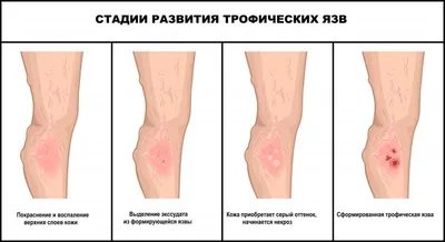 Трофические язвы — почему образуются и что делать? | Evolutis Clinic | Дзен